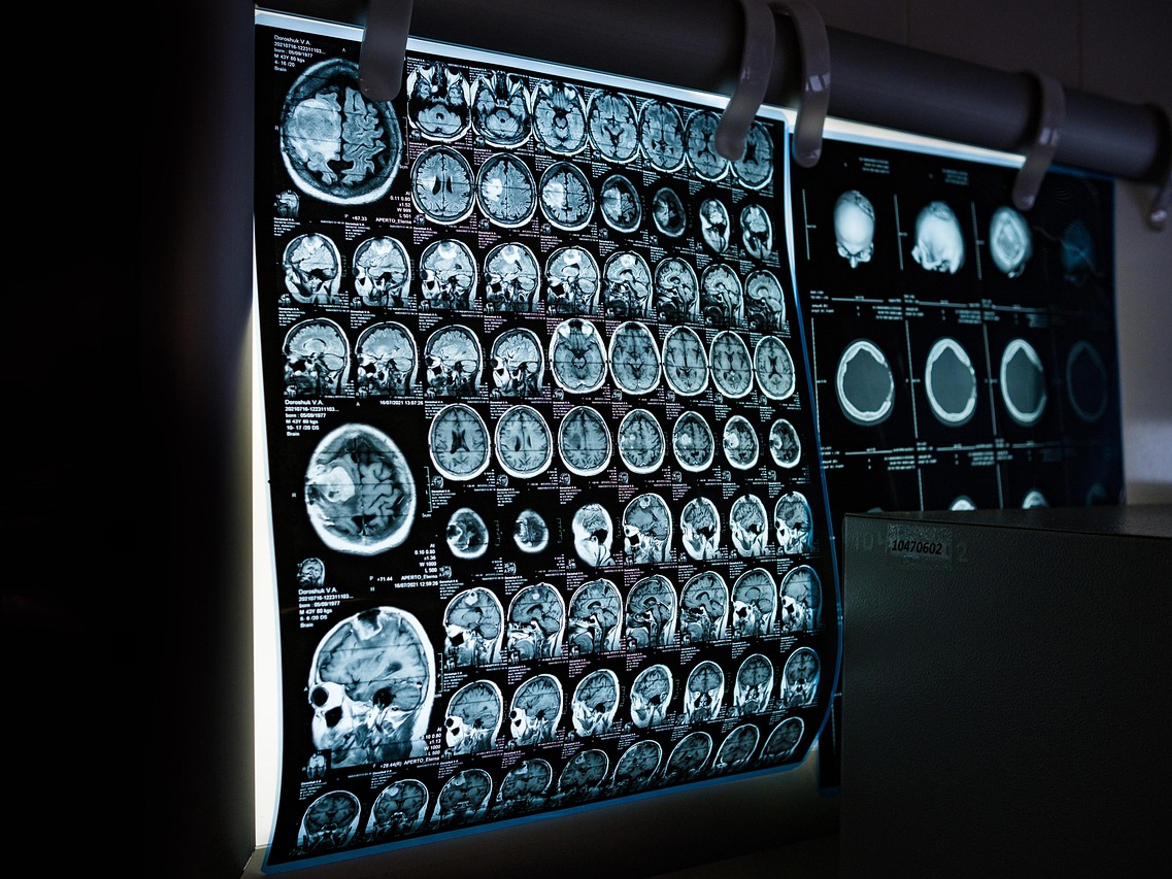 Doctor reviewing a brain MRI scan on a lightbox