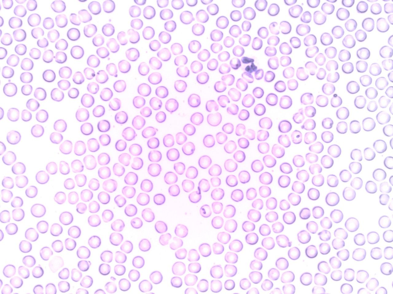 Microscope view of a blood smear showing a white blood cell among red blood cells