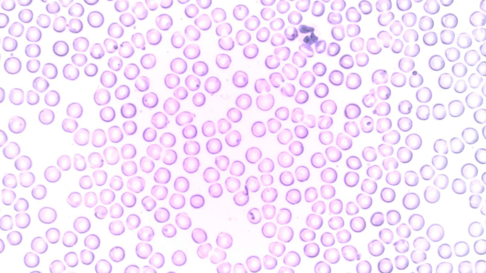 Microscope view of a blood smear showing a white blood cell among red blood cells
