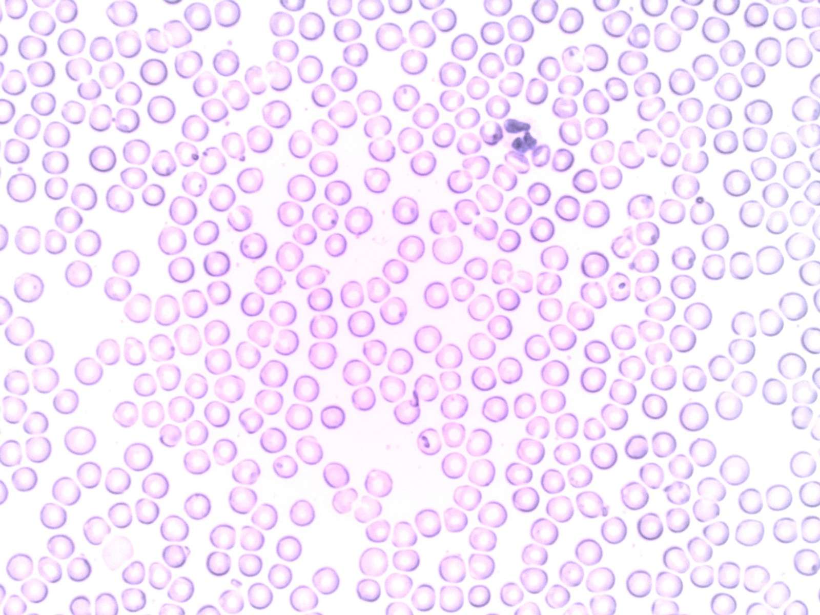 Microscope view of a blood smear showing a white blood cell among red blood cells