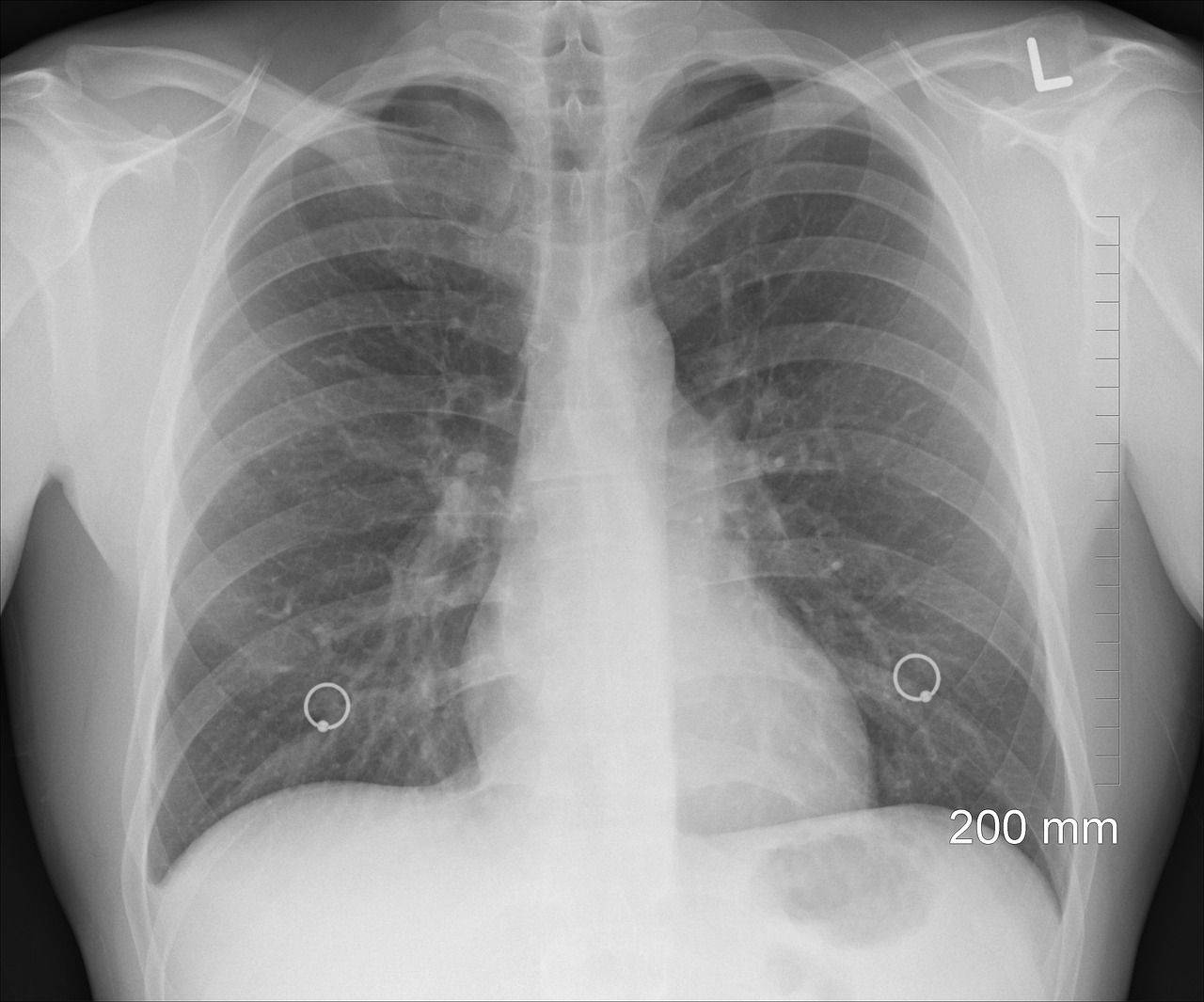 A chest X-ray showing the lungs and ribs