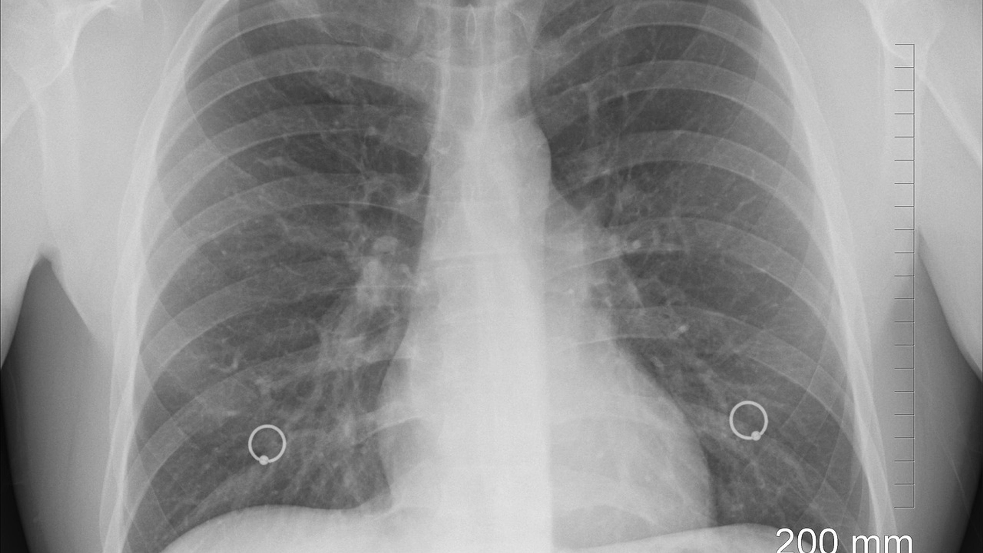 A chest X-ray showing the lungs and ribs