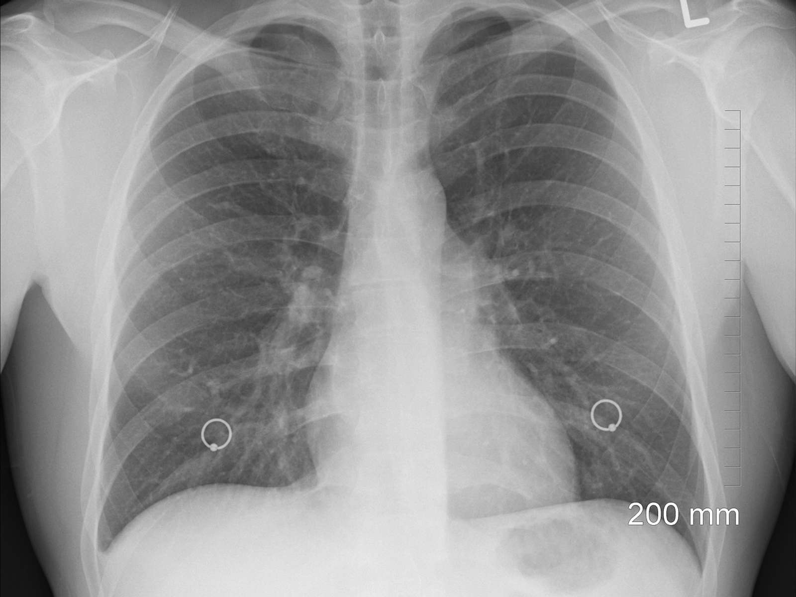A chest X-ray showing the lungs and ribs