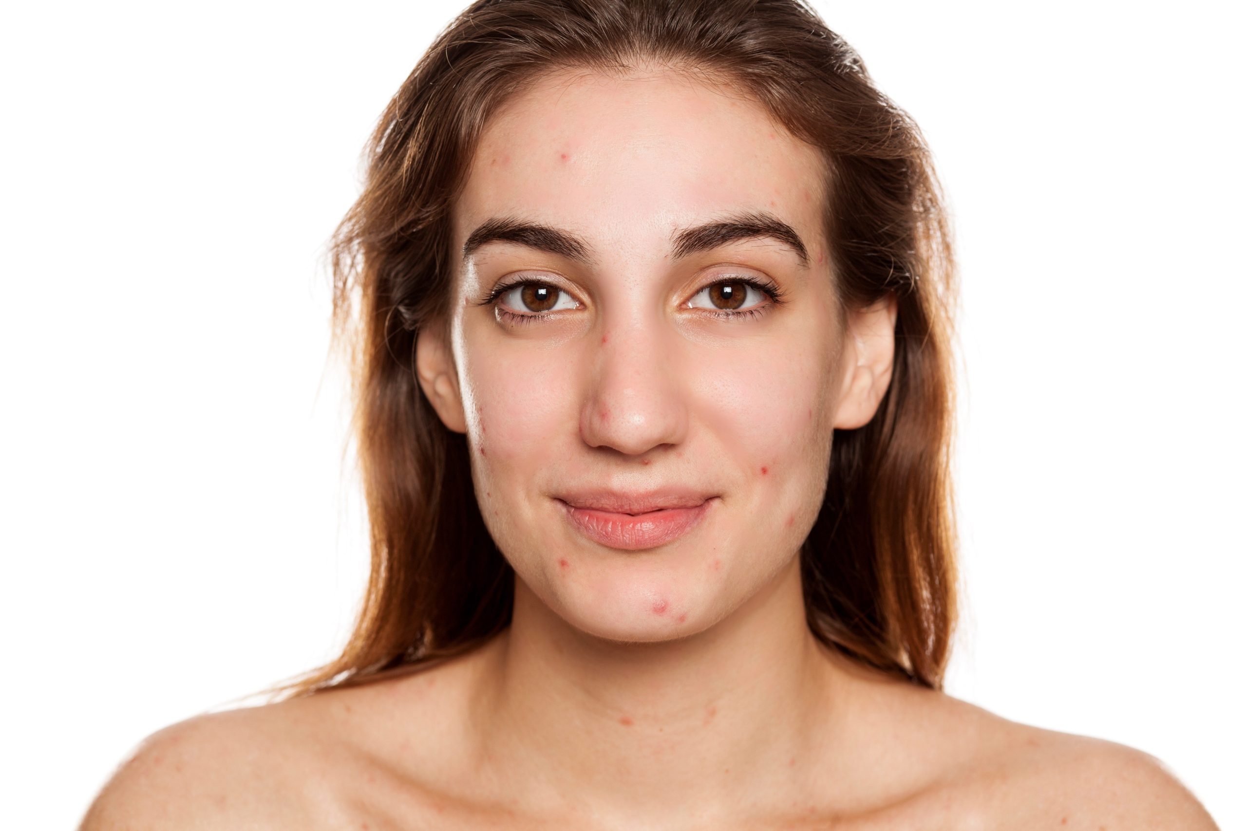Woman with visible acne blemishes on her face