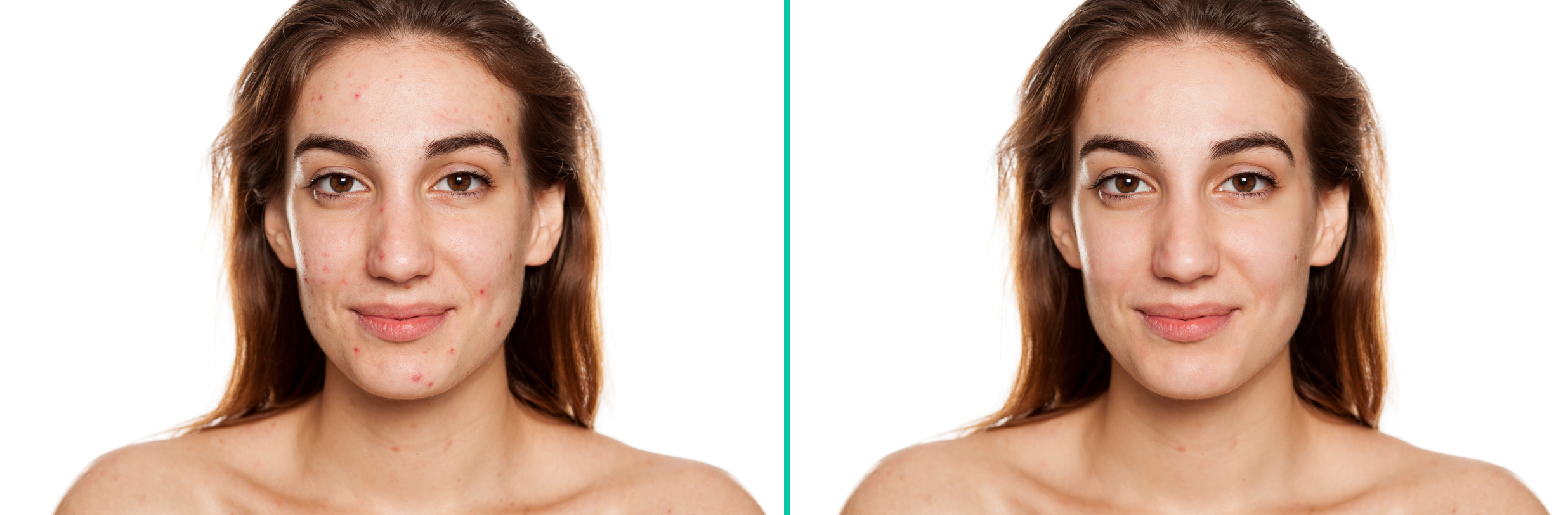 Woman’s face before and after blemish removal