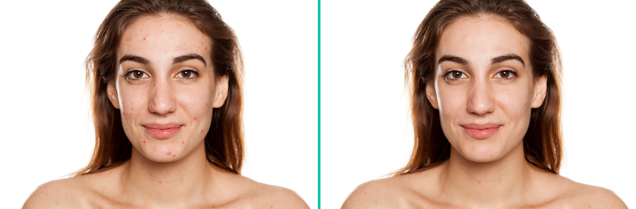 Woman’s face before and after blemish removal