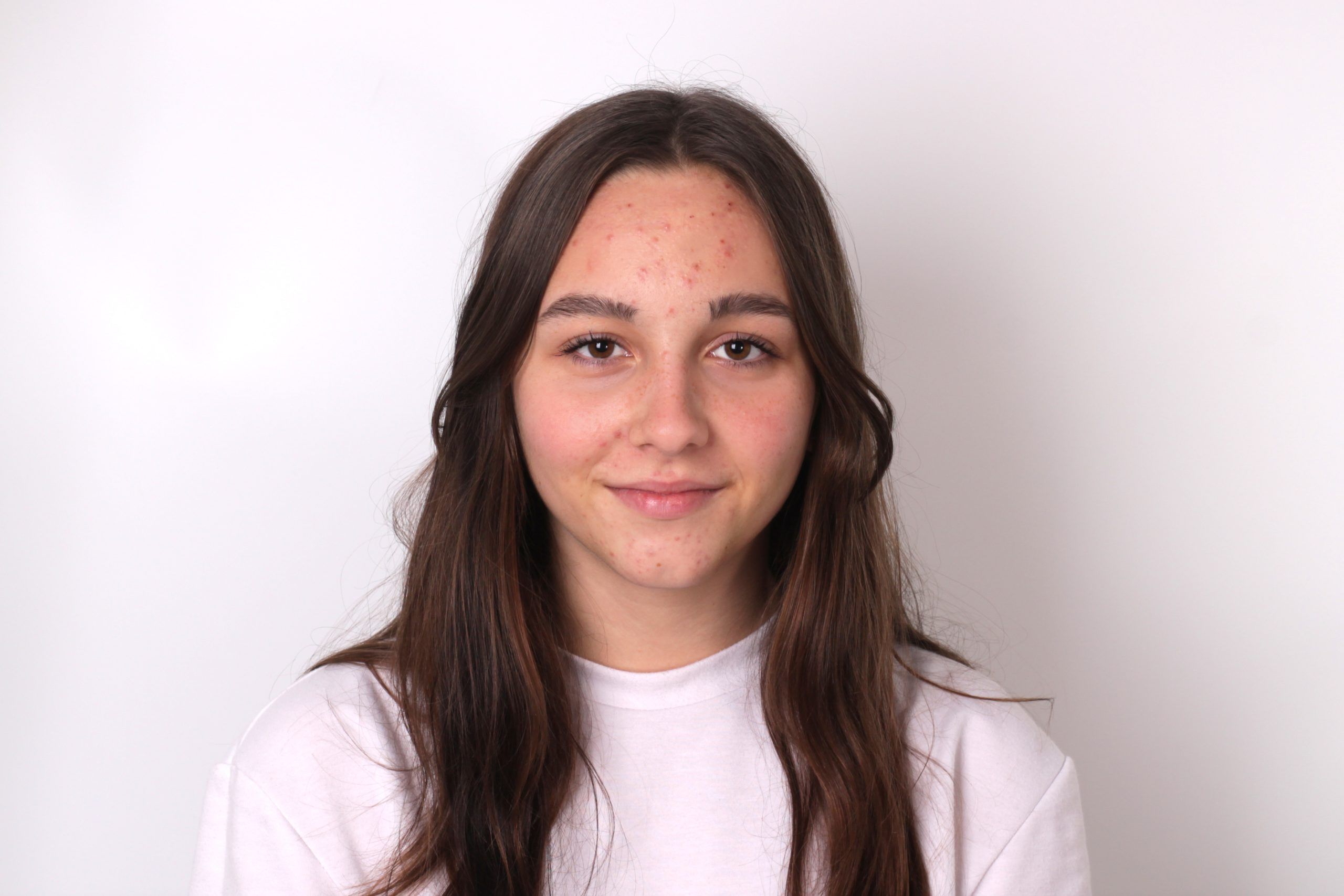Young woman with facial acne looking at the camera