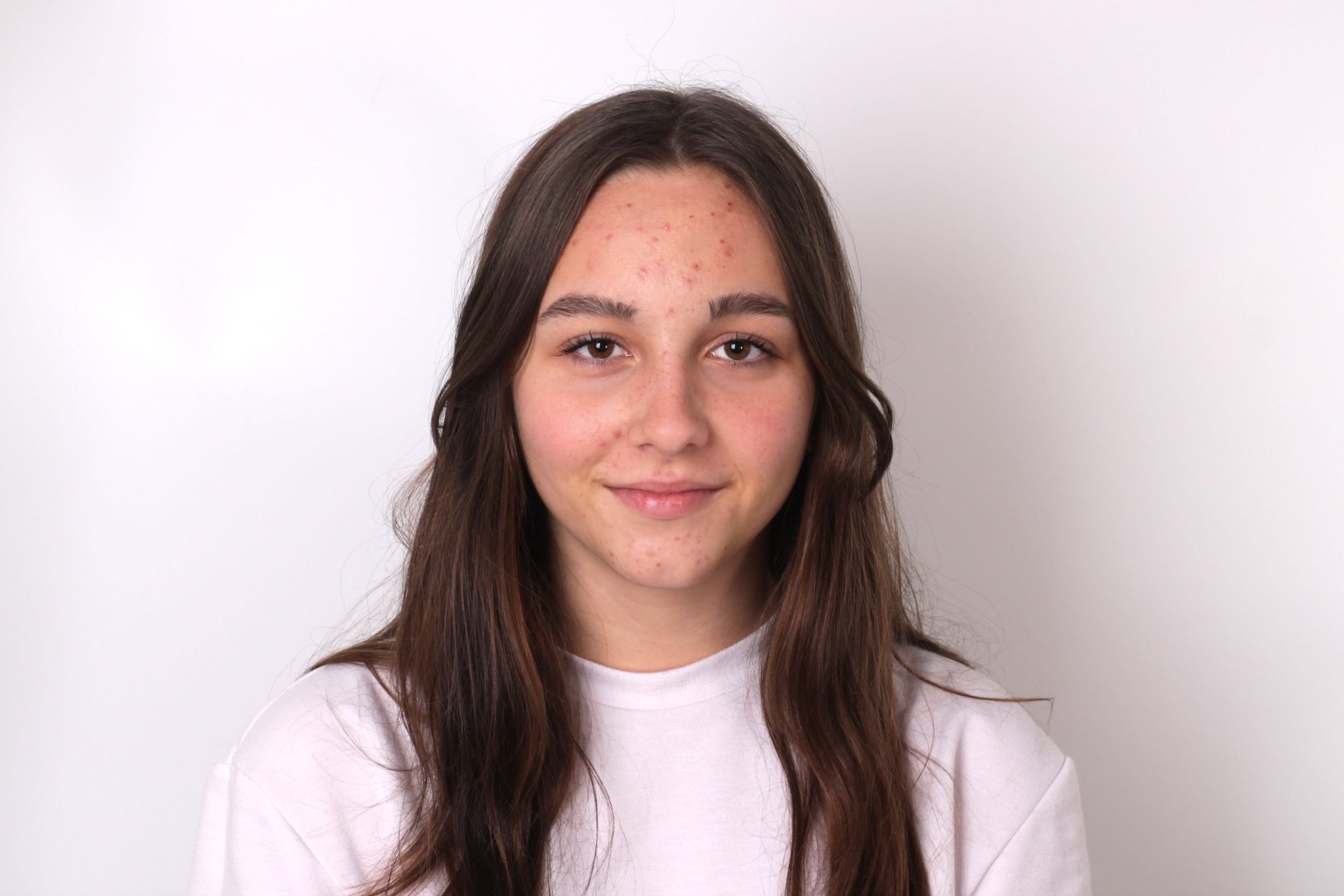 Young woman with facial acne looking at the camera