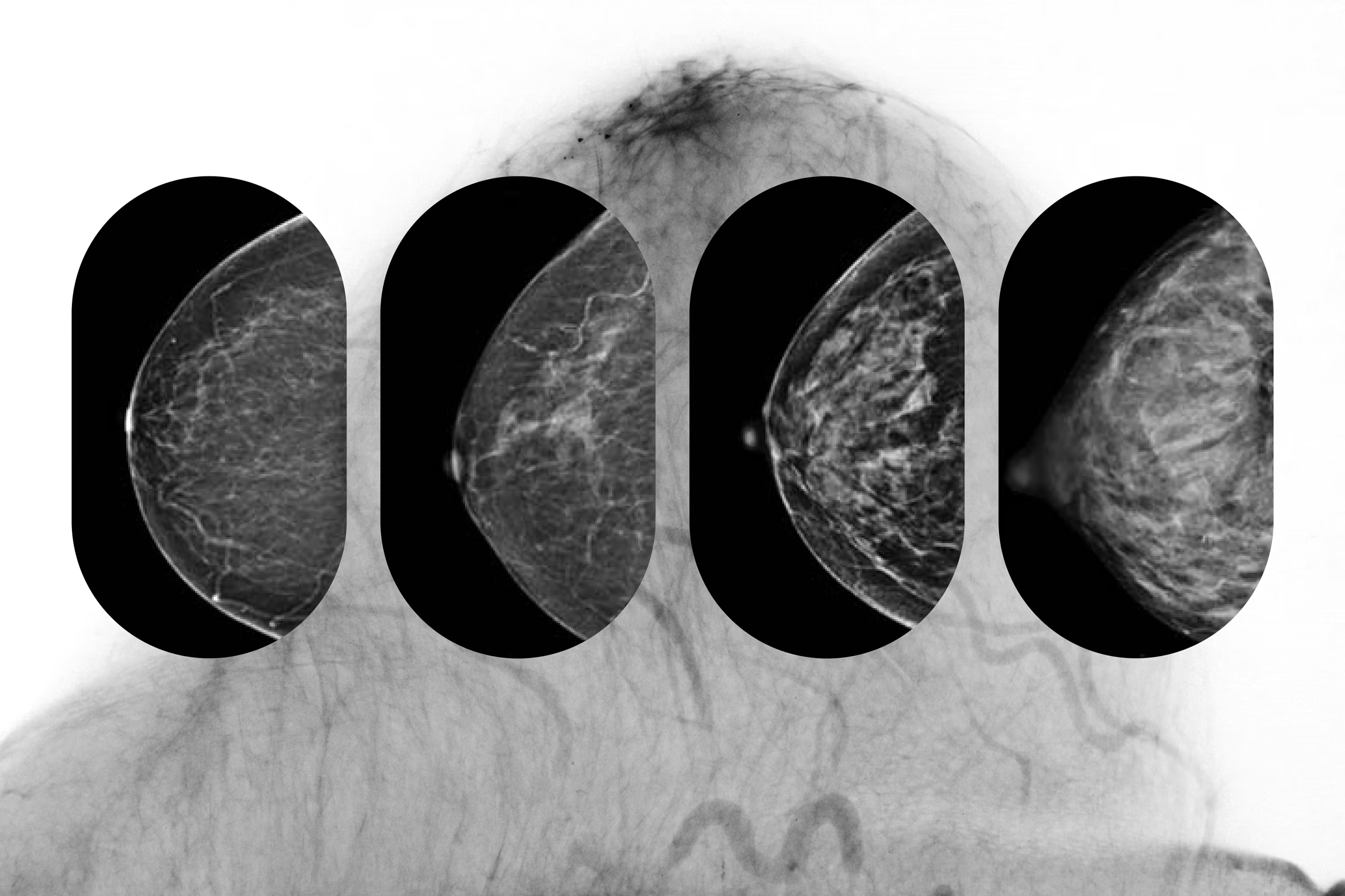 Illustration of dense breast tissue on a mammogram