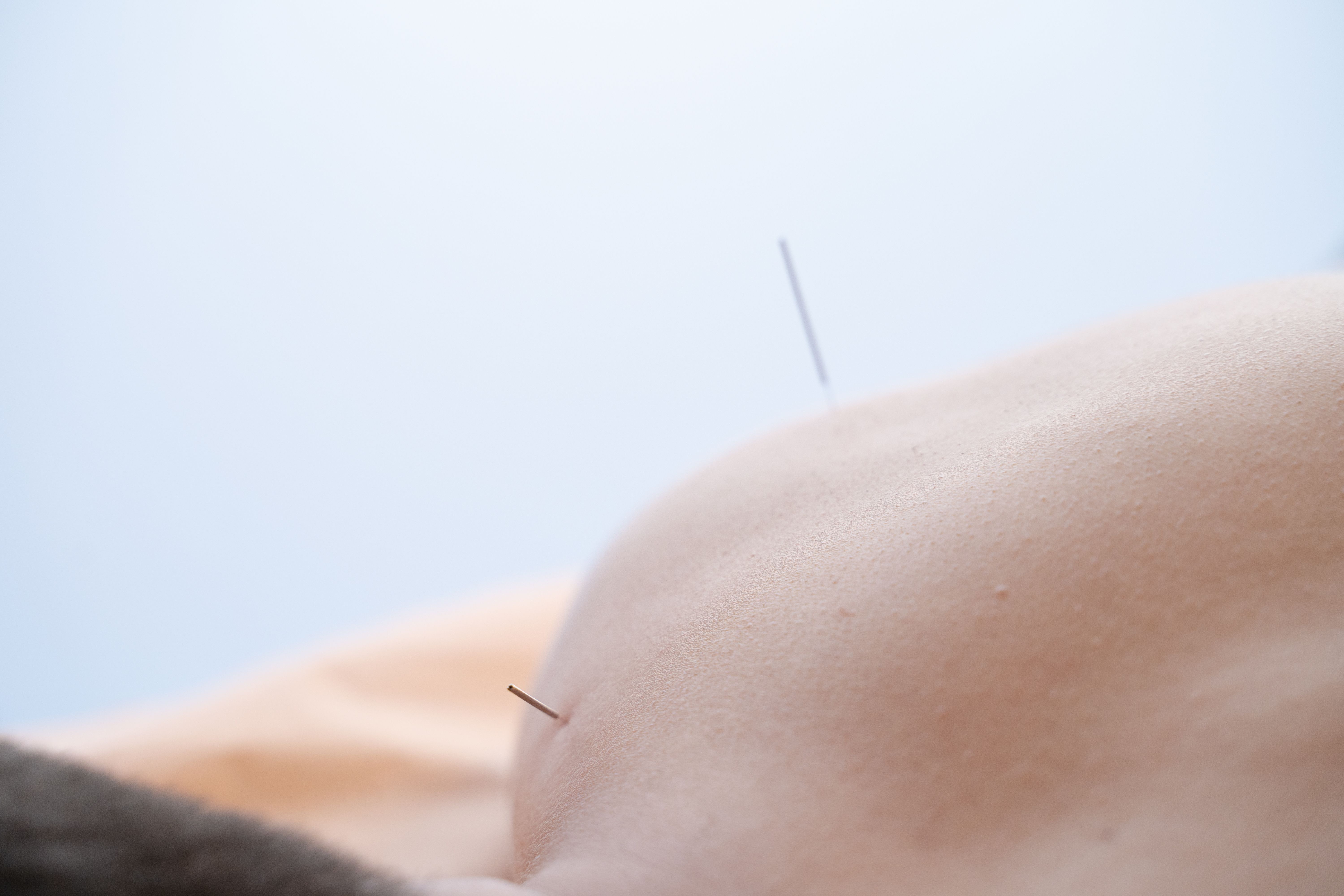 Aguja de acupuntura aplicada en sesión de tratamiento del dolor