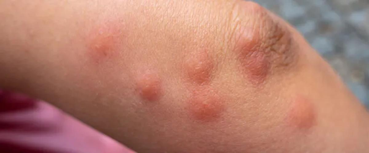 Detection and Early Signs