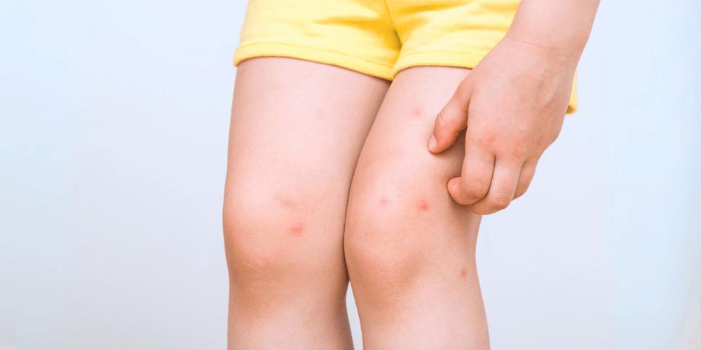 2-Why-Effective-Bed-Bug-Elimination-is-Critical