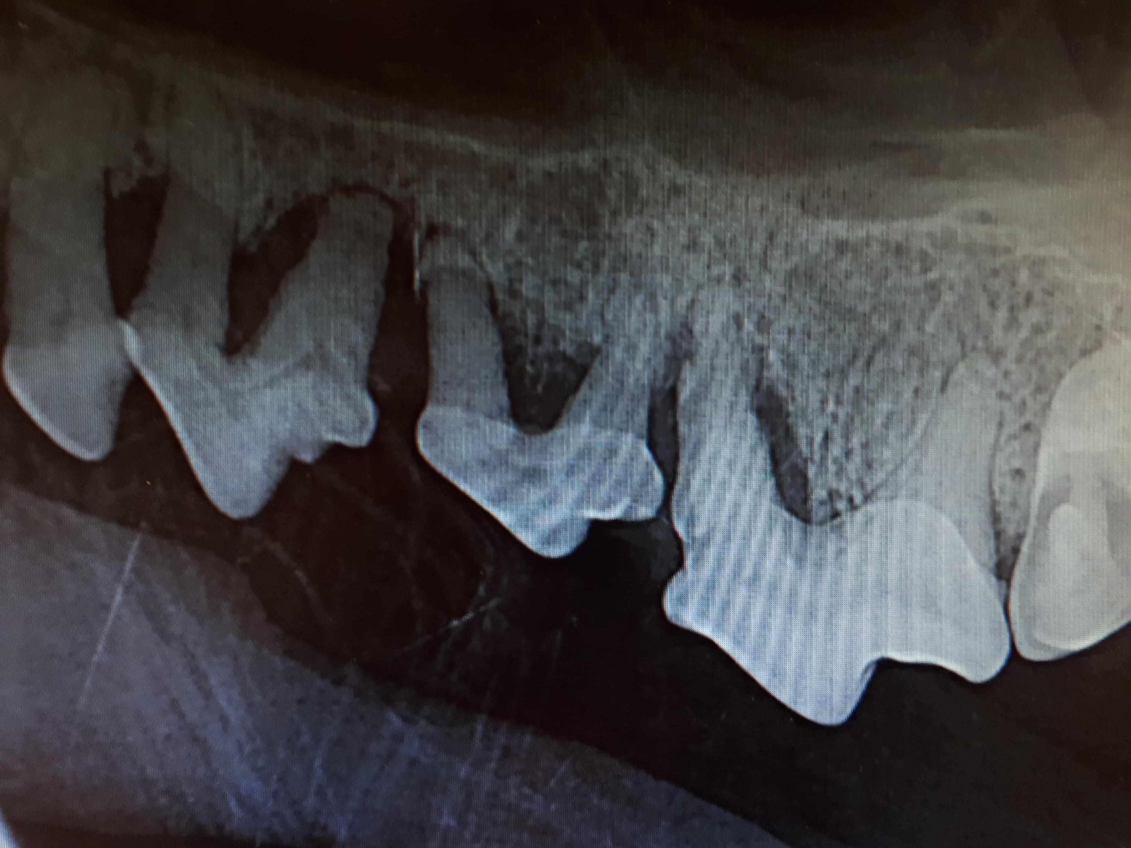 Røntgen av periodontitt