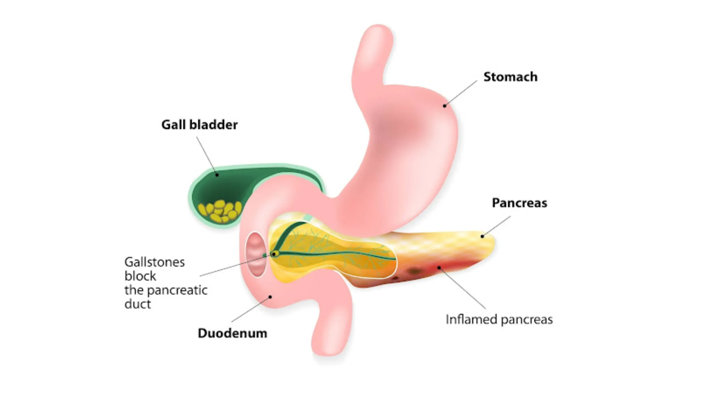 Acute Pancreatitis