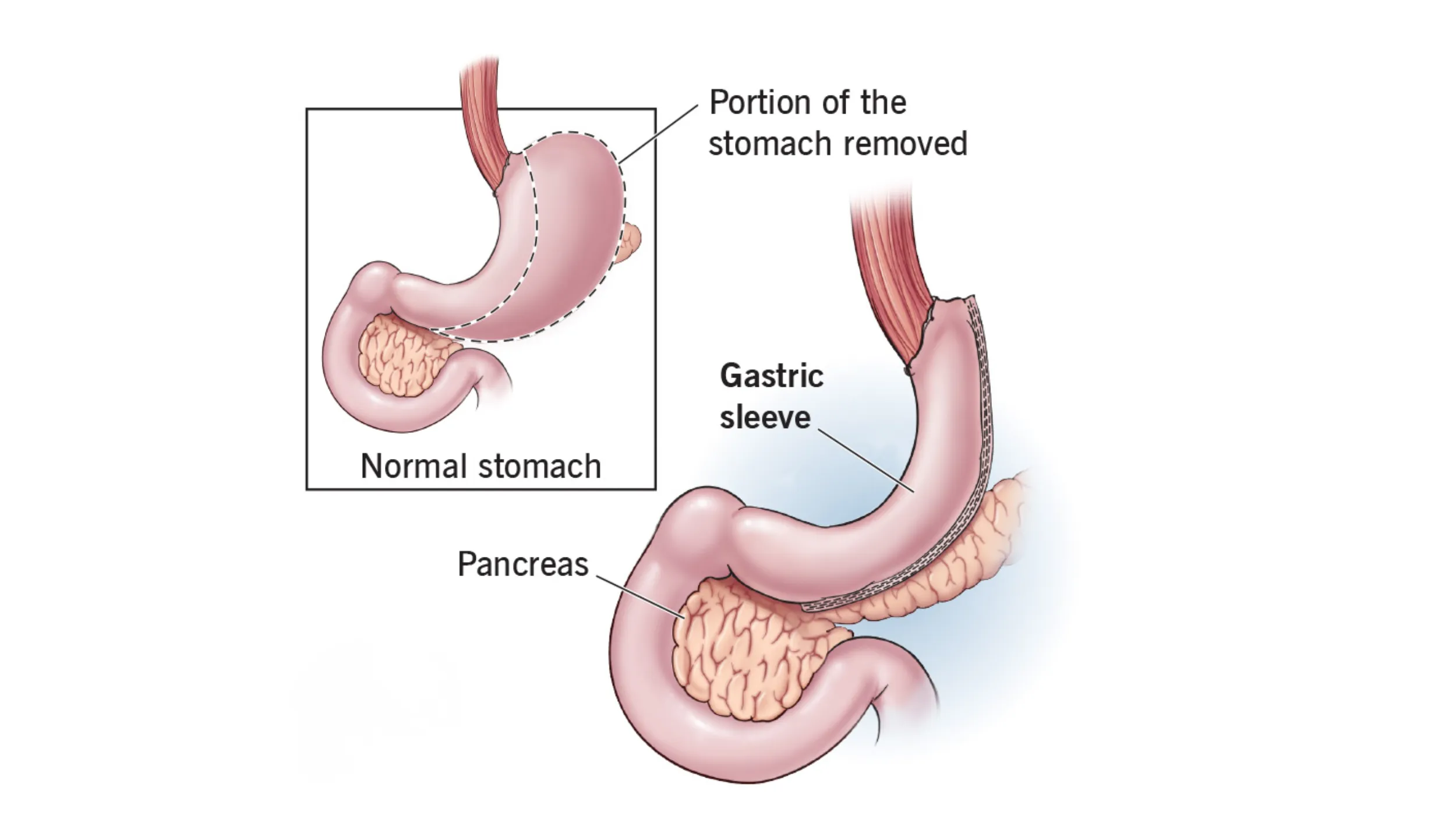 Sleeve Gastrectomy