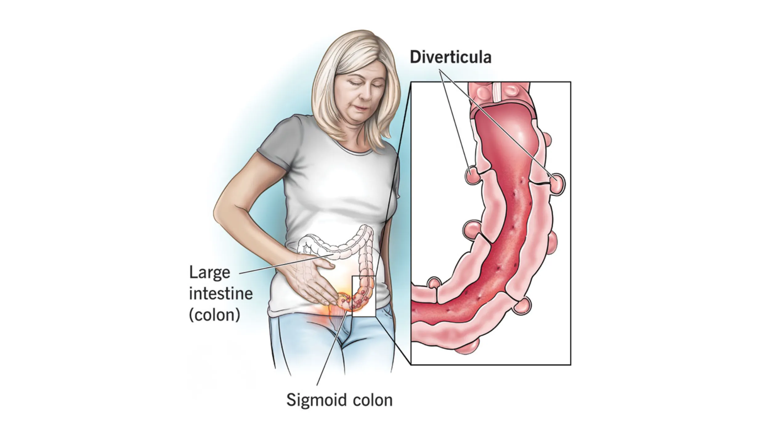 Diverticulitis