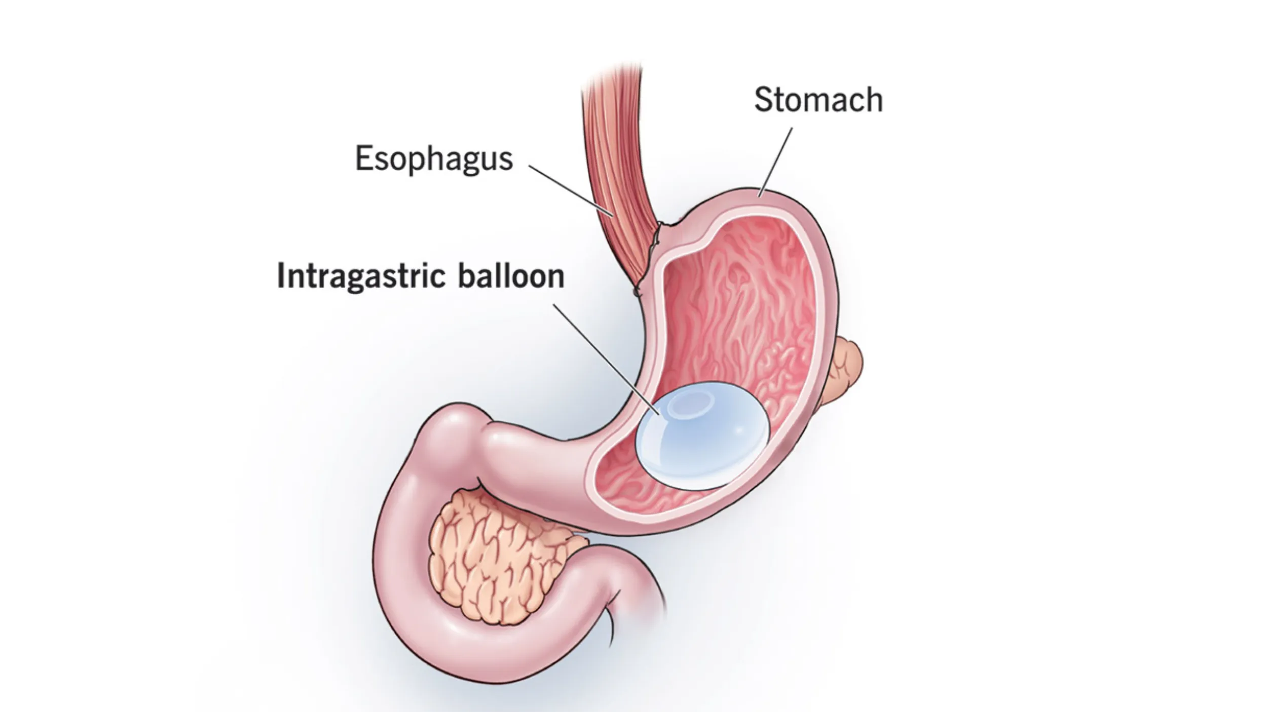 Gastric Balloon for Obesity Management