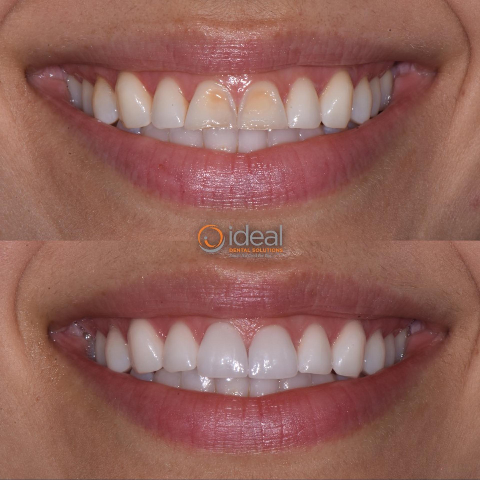 Before and after smile, case 13