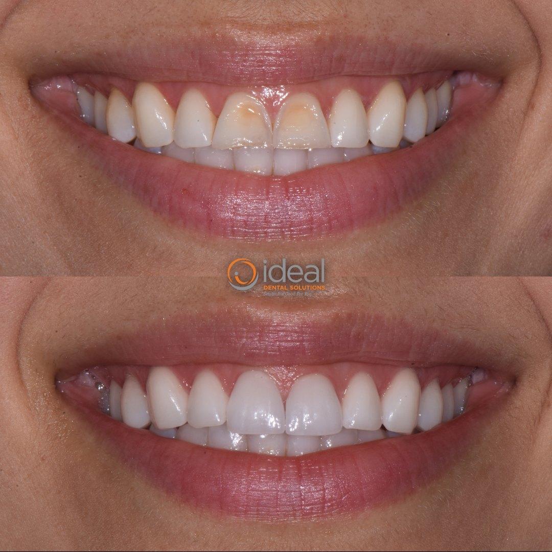 Before and after smile, case 13