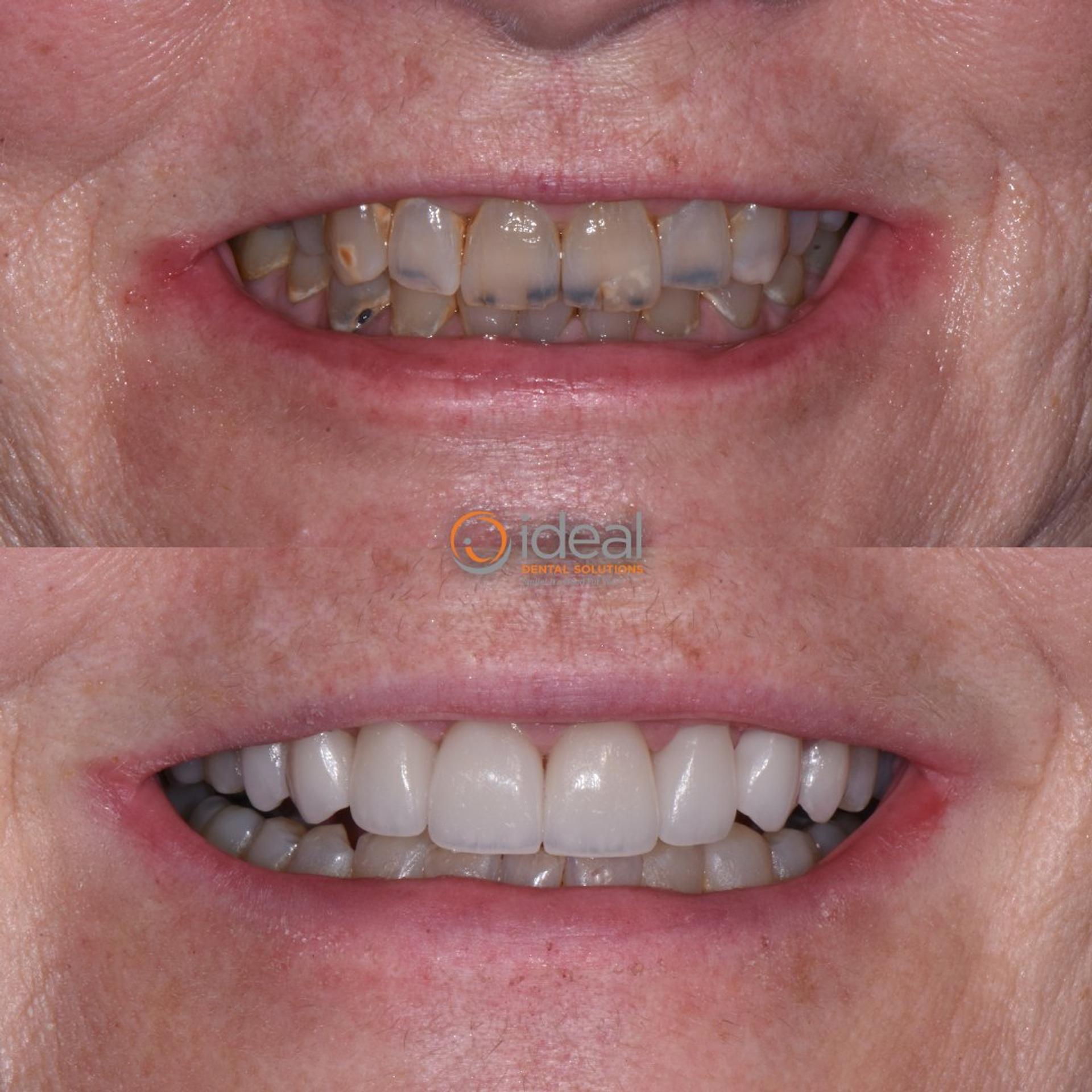 Before and after smile, case 10
