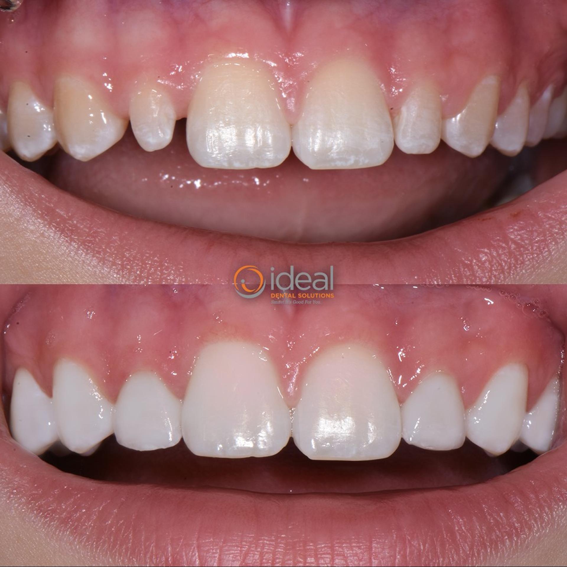Before and after smile, case 15