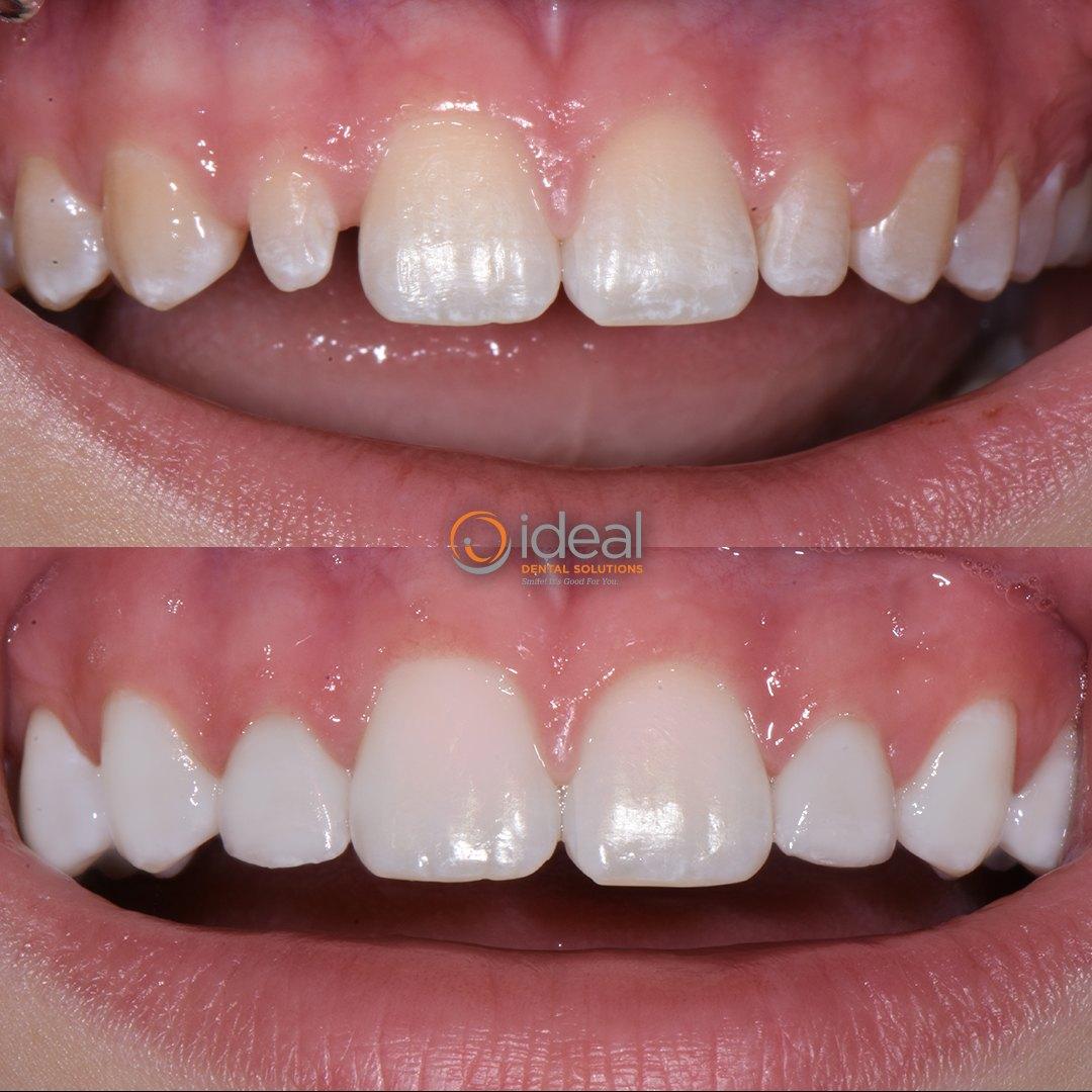 Before and after smile, case 15