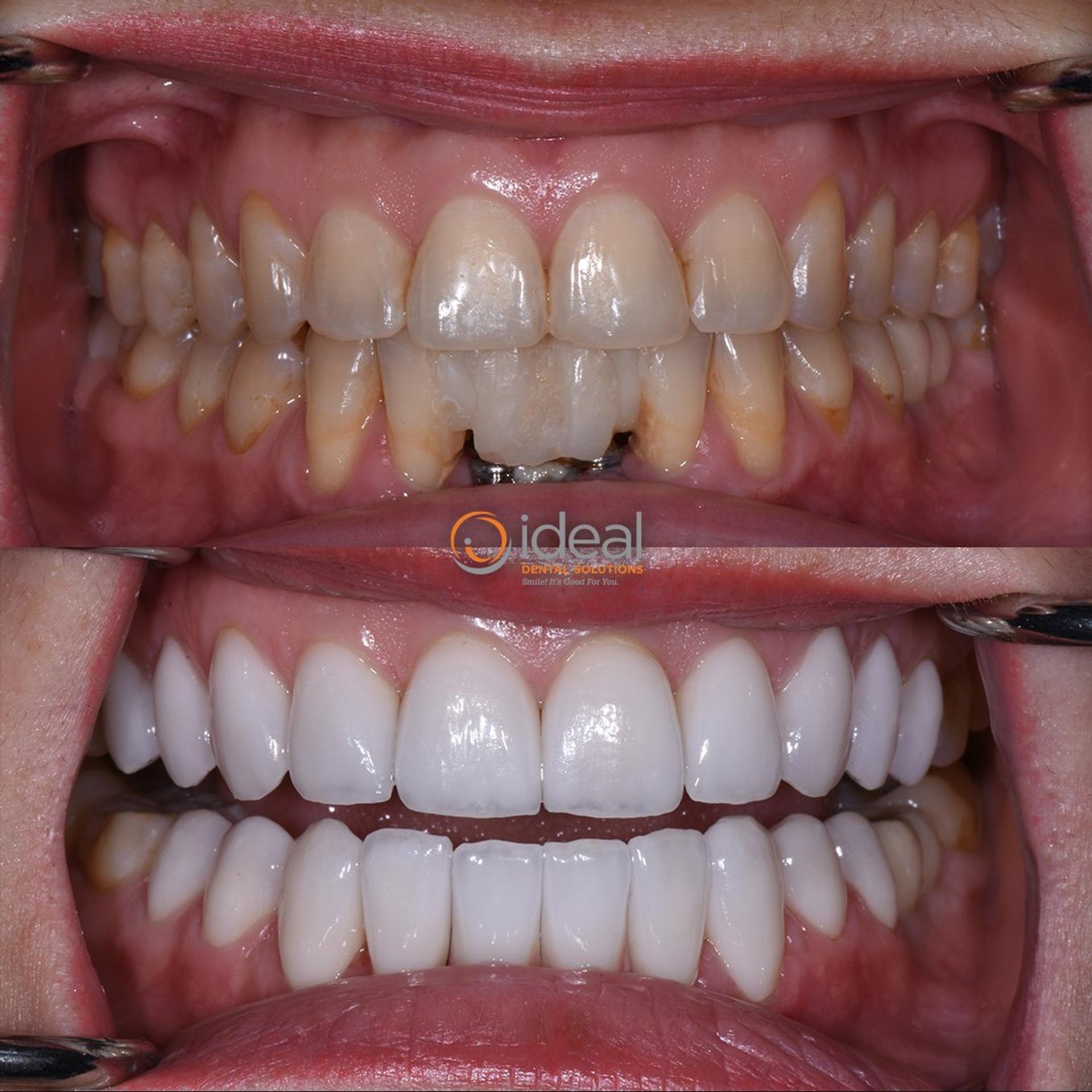 Before and after smile, case 6