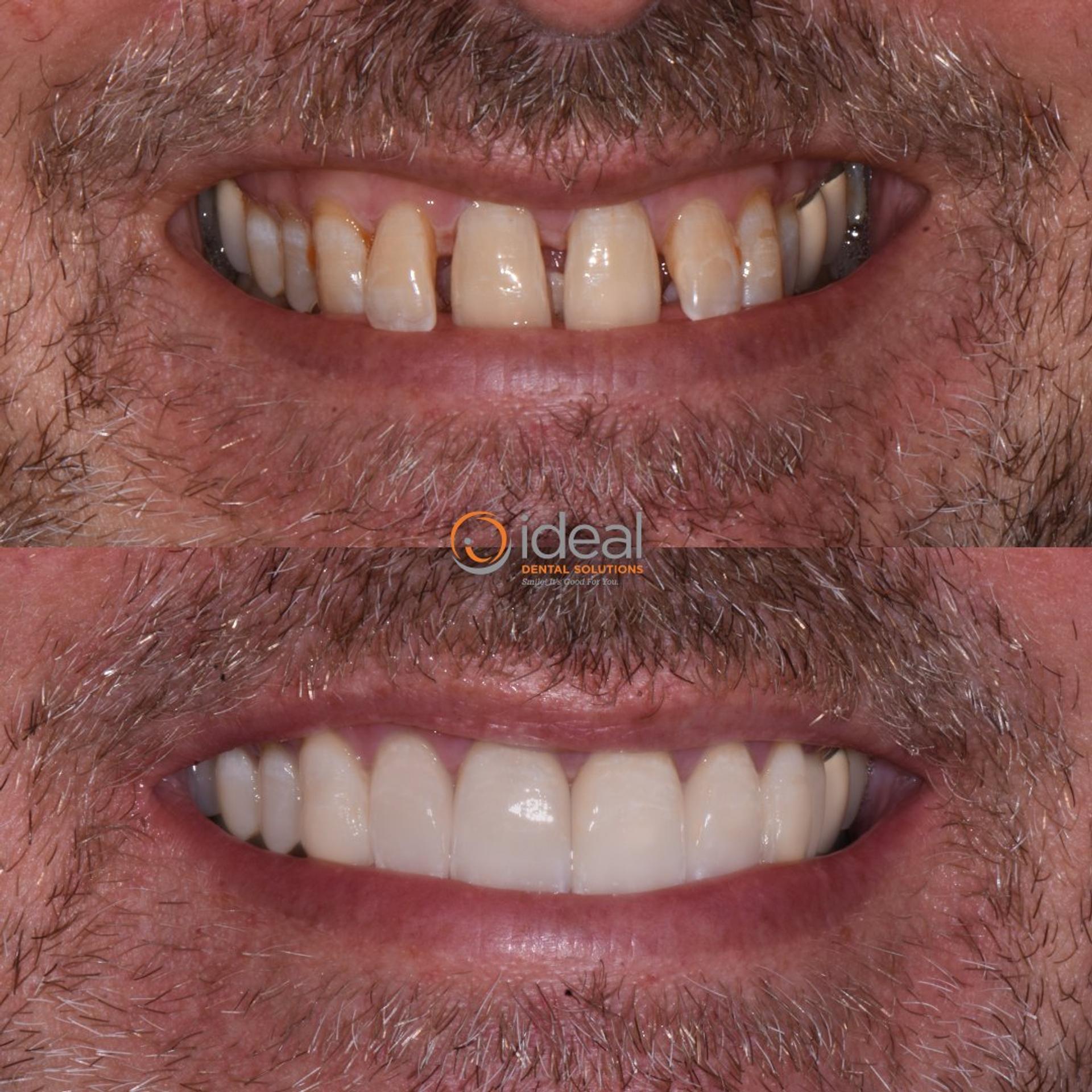 Before and after smile, case 20