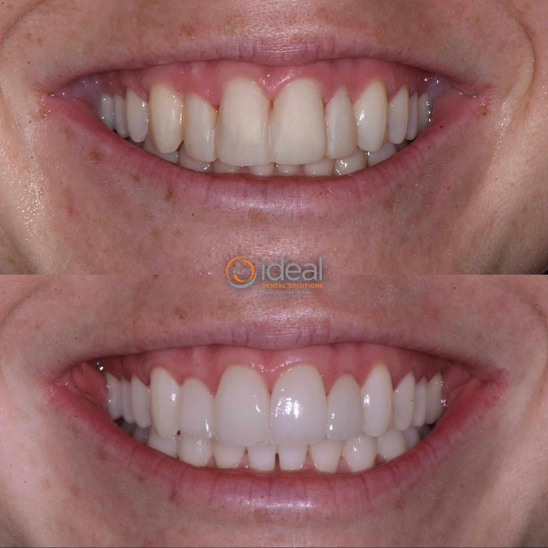 Before and after smile, case 17