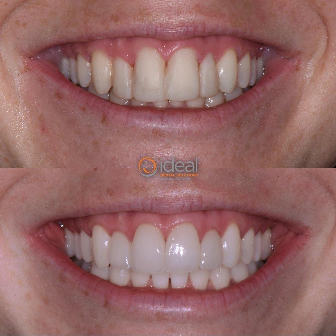 Before and after smile, case 17
