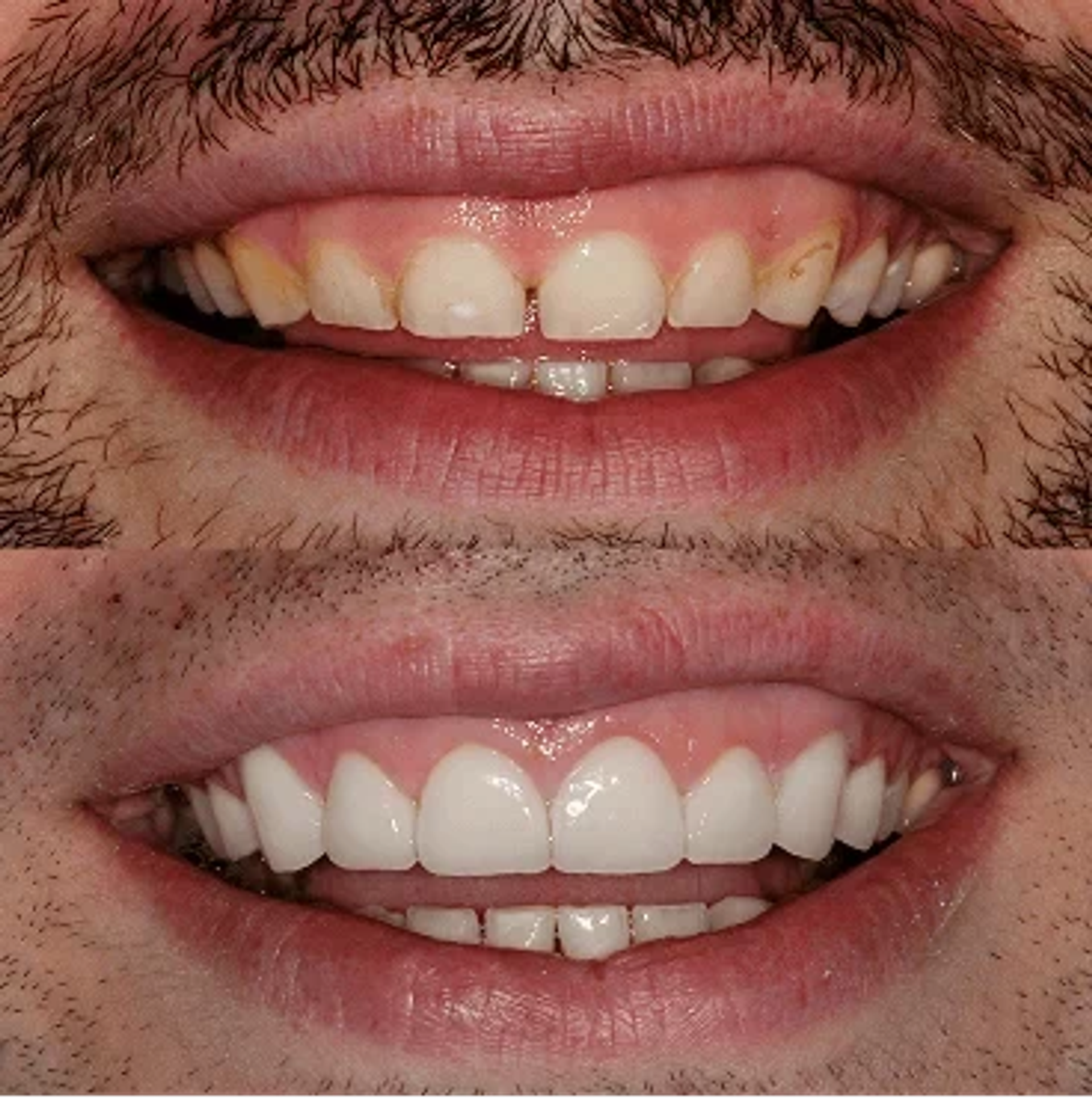 Before and after smile, case 1