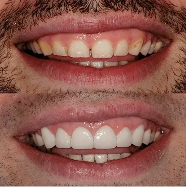 Before and after smile, case 1