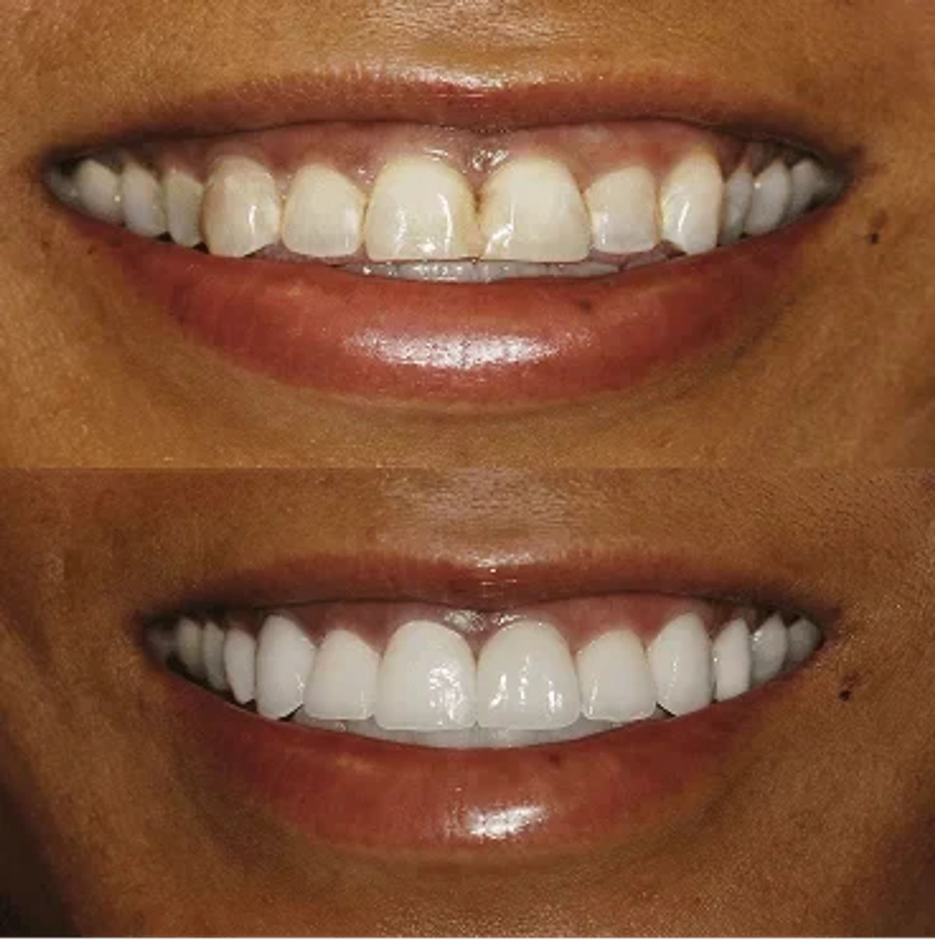 Before and after smile, case 2