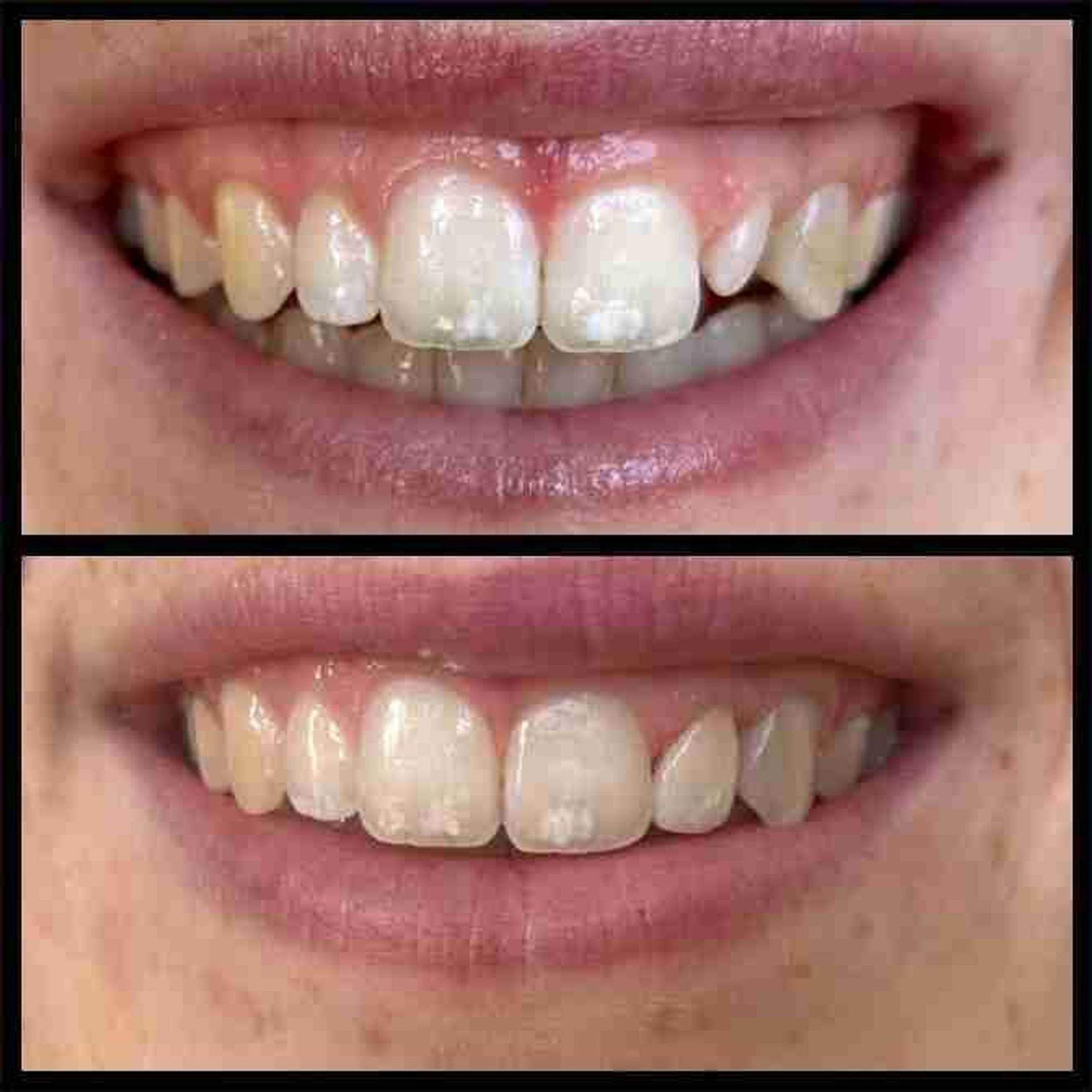 Before and after smile result