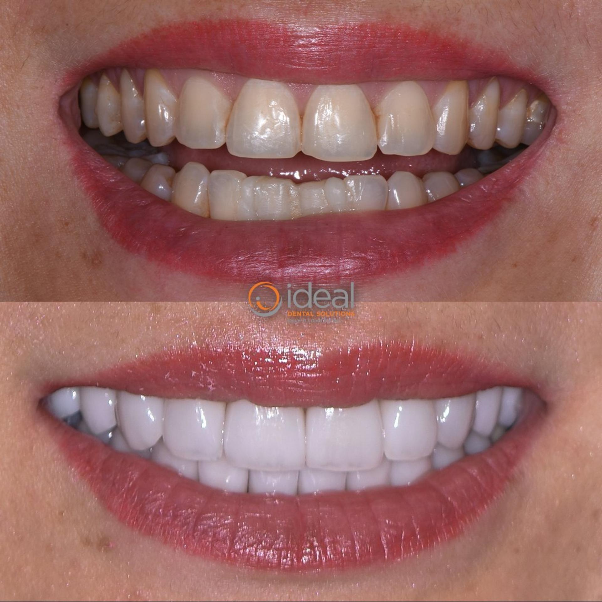 Before and after smile, case 5