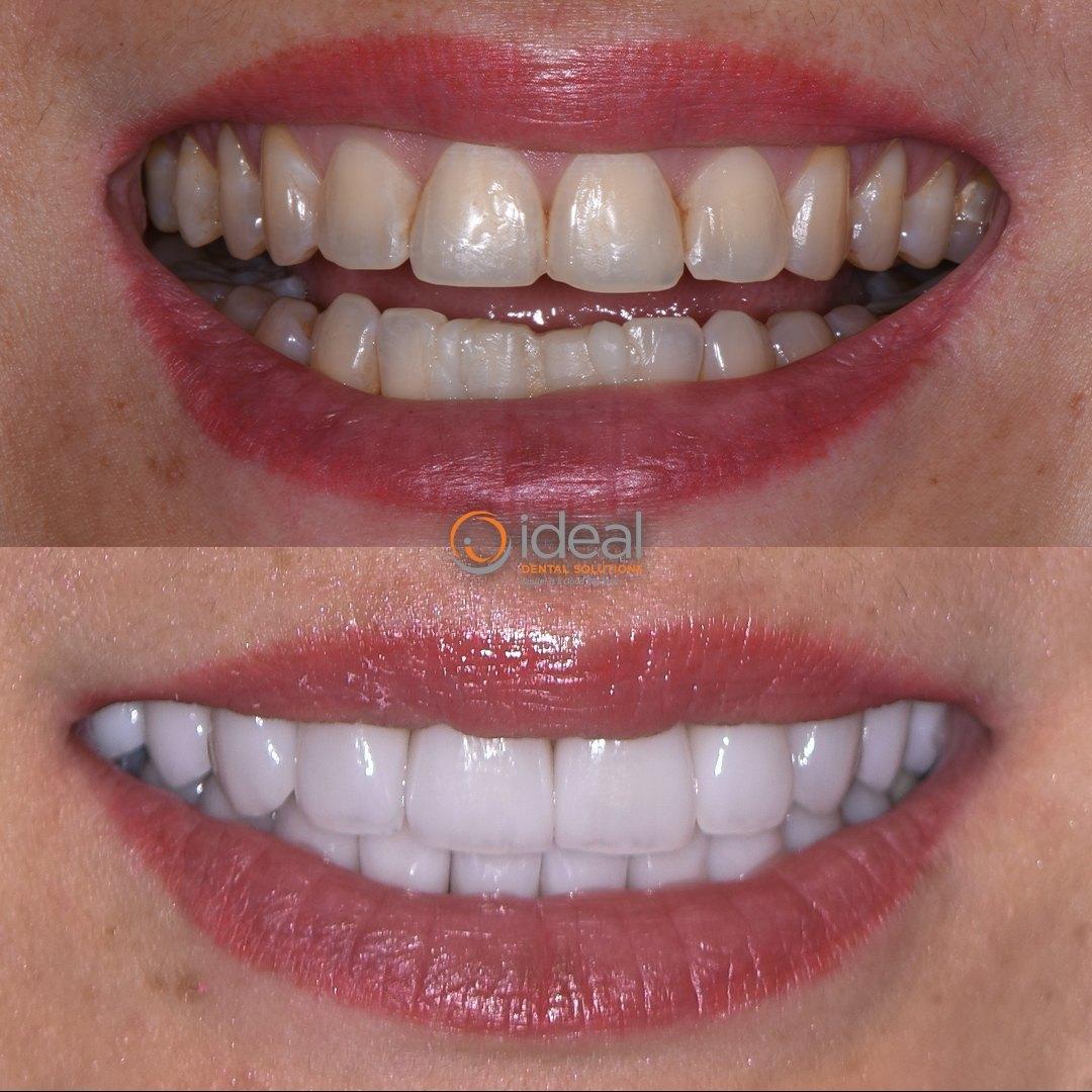 Before and after smile, case 5