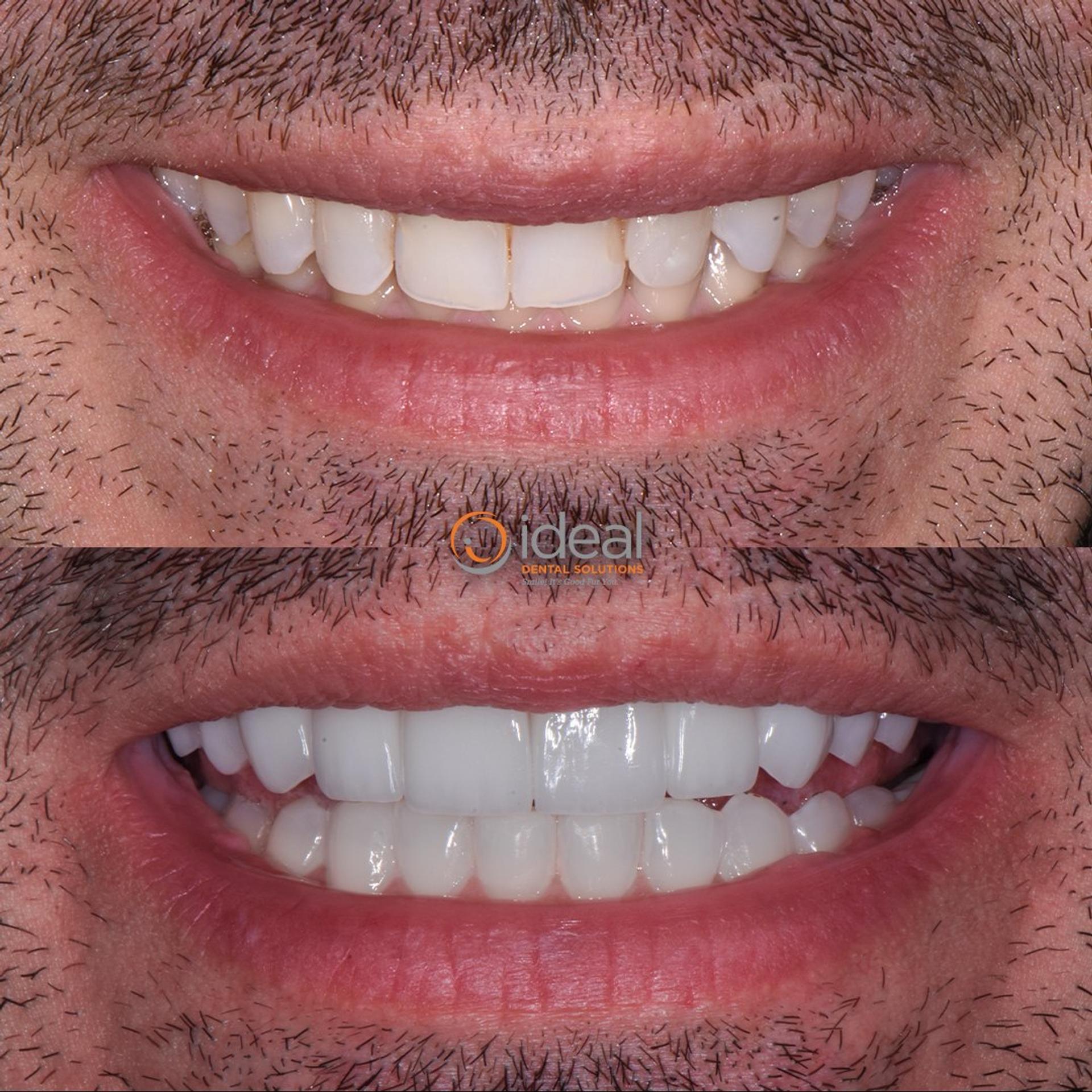 Before and after smile, case 12