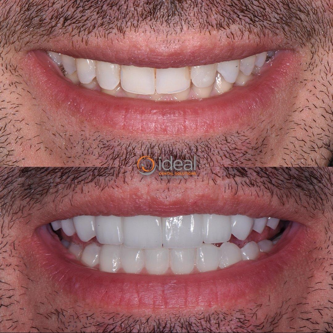 Before and after smile, case 12