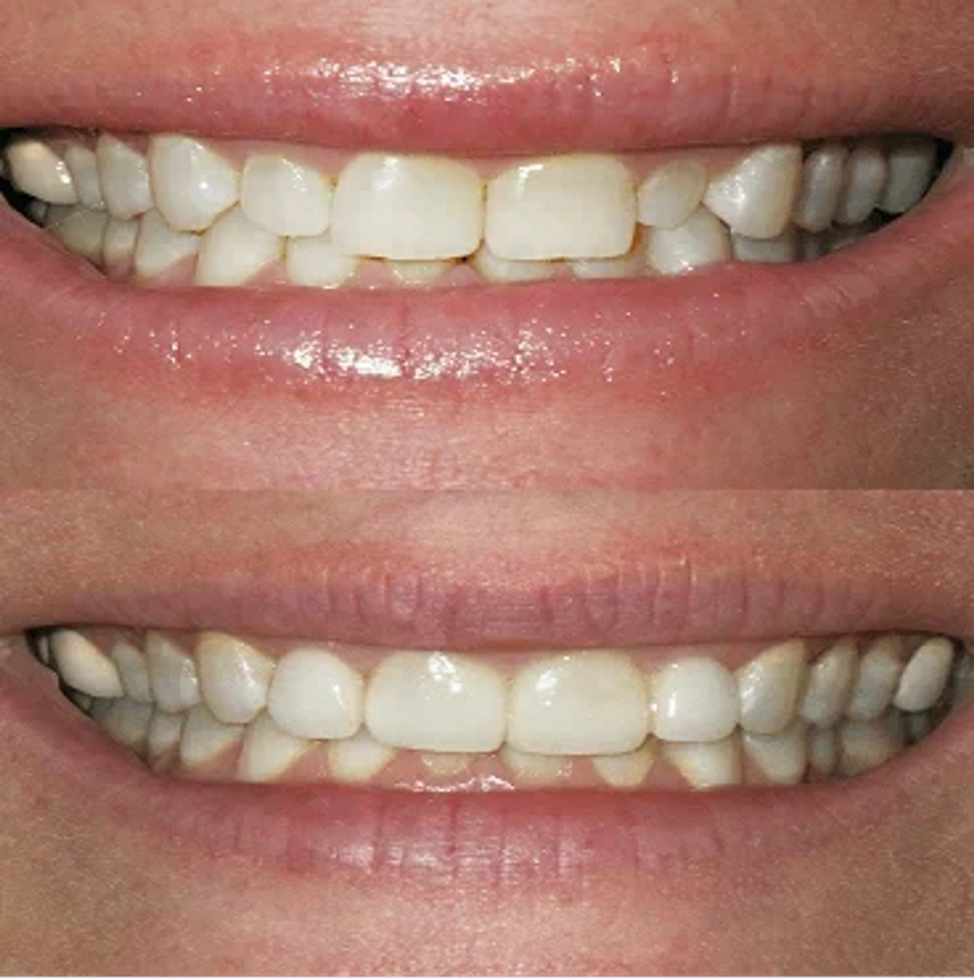 Before and after smile, case 3