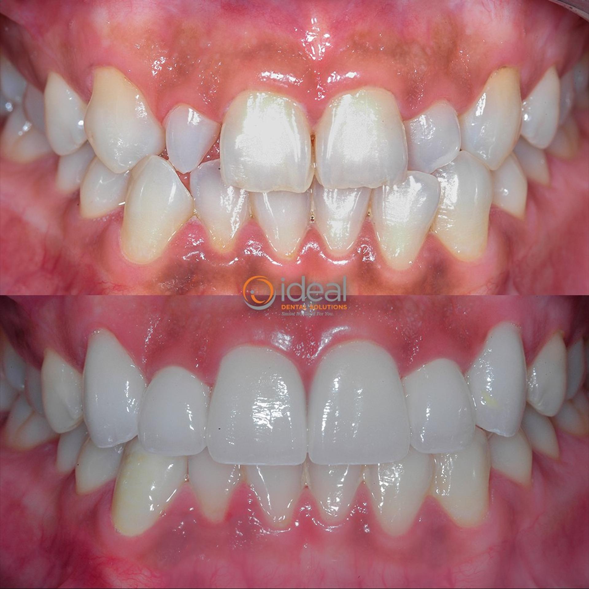 Before and after smile, case 11