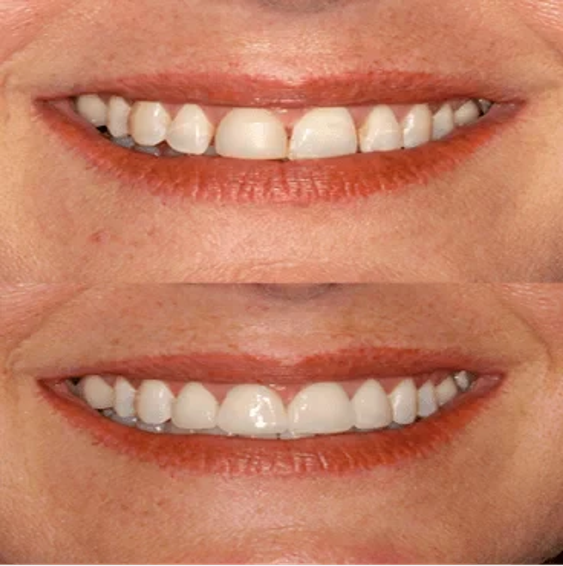 Before and after smile, case 6