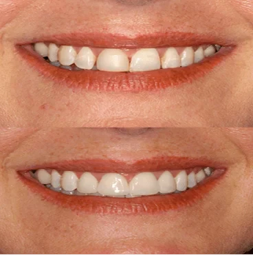 Before and after smile, case 6