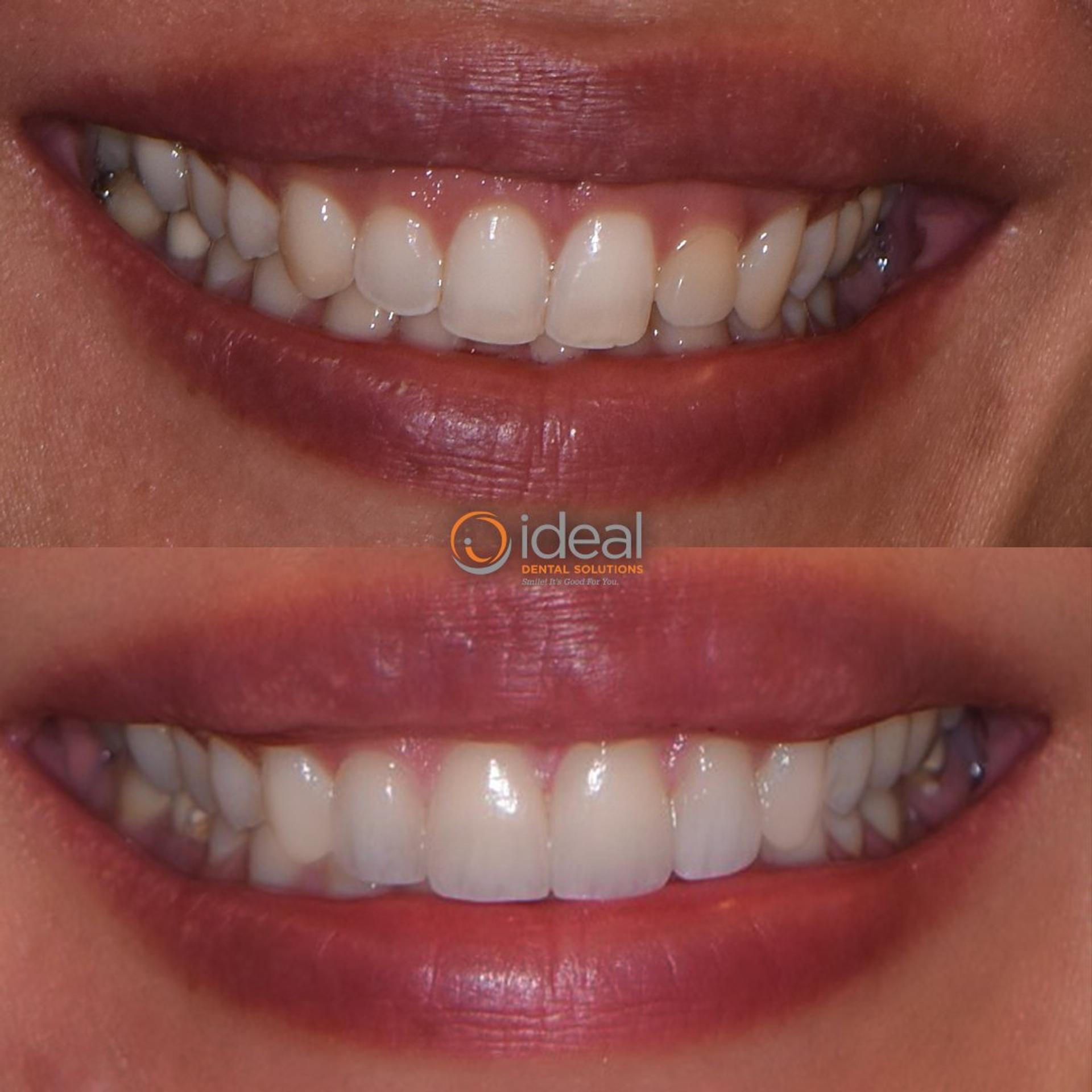 Before and after smile, case 9