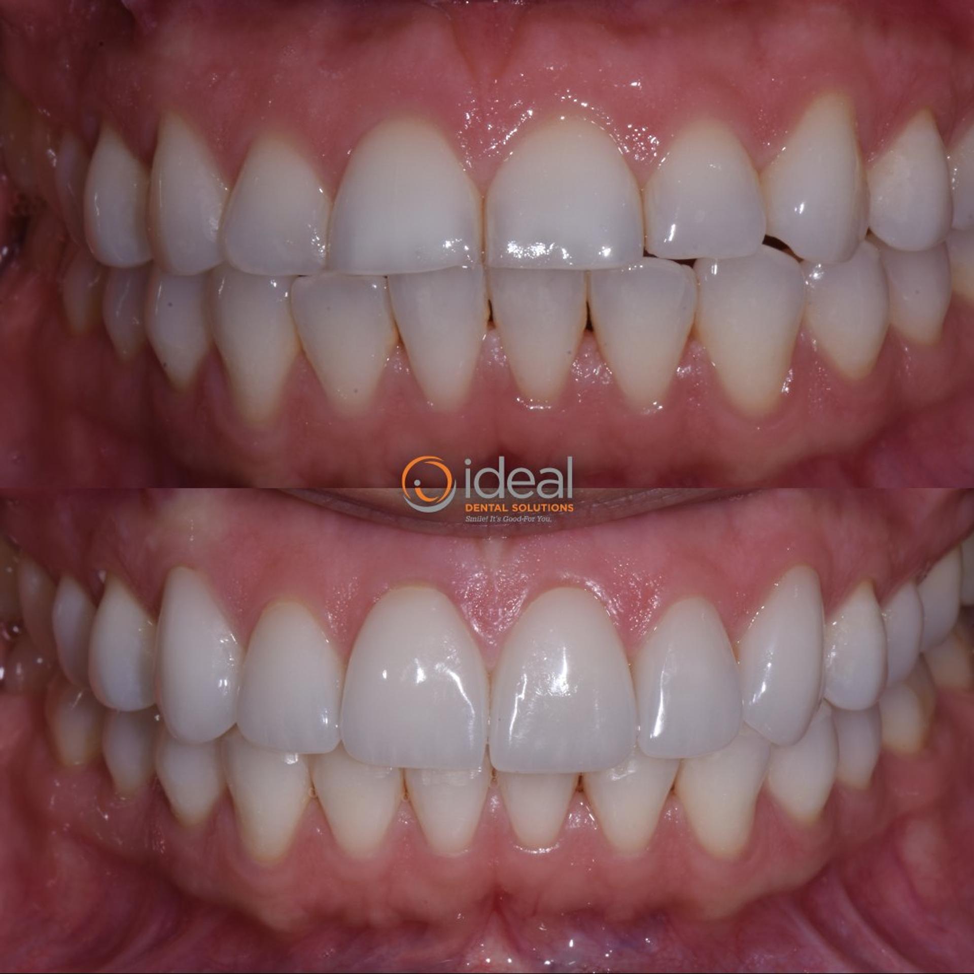 Before and after smile, case 8