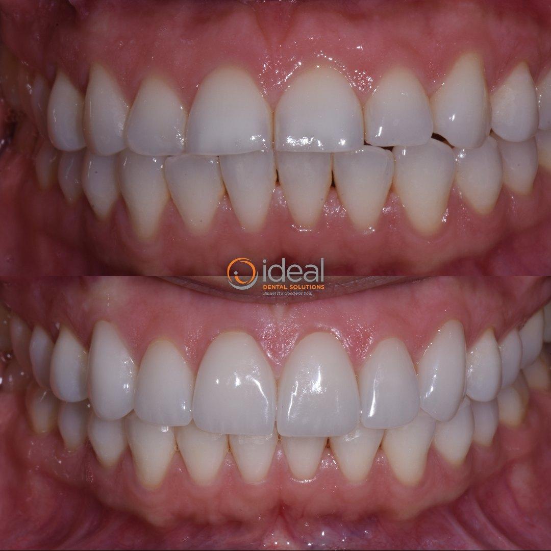 Before and after smile, case 8
