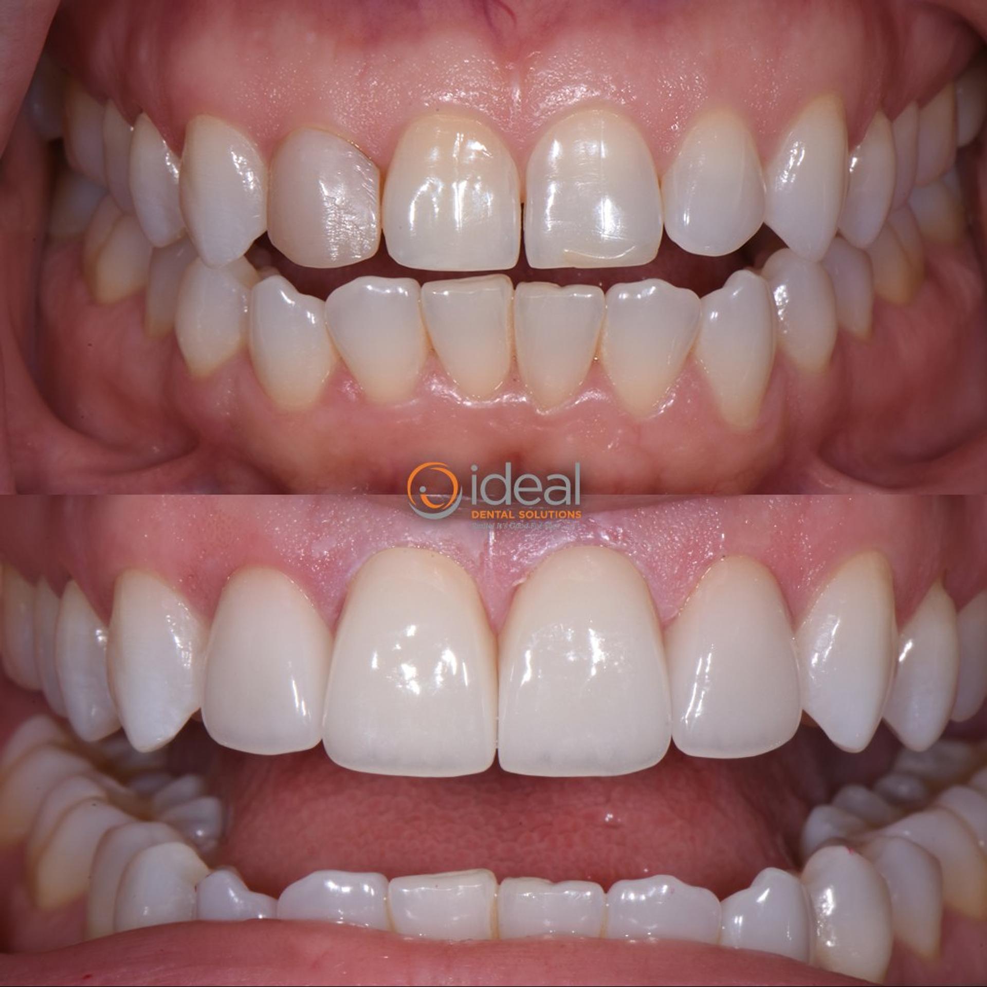 Before and after smile, case 19