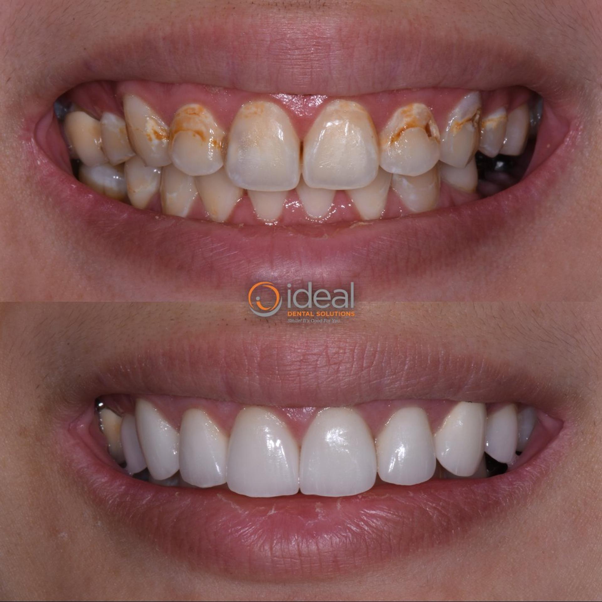 Before and after smile, case 2