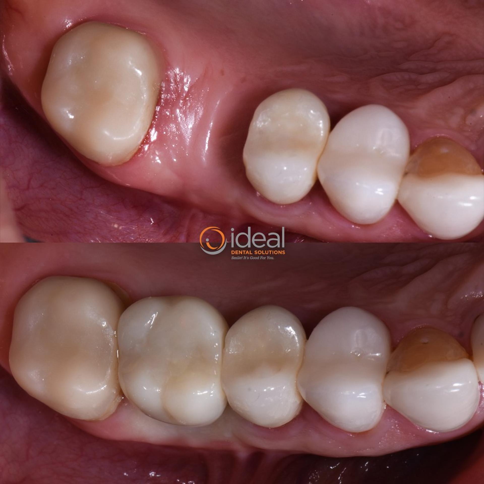 Before and after smile, case 3