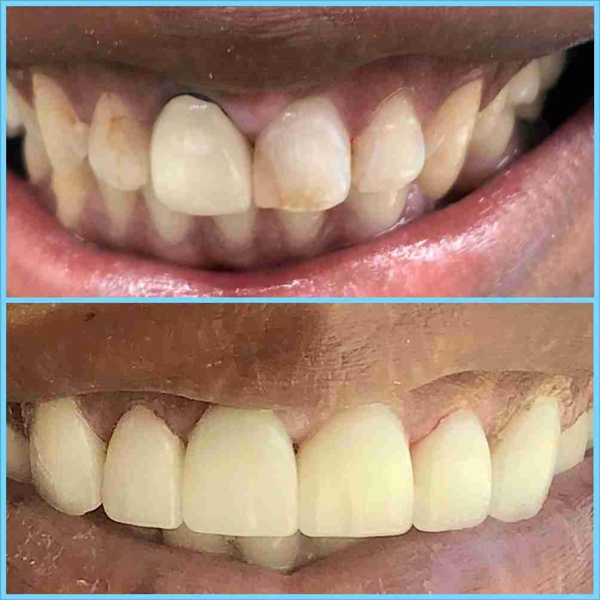 Before and after smile result