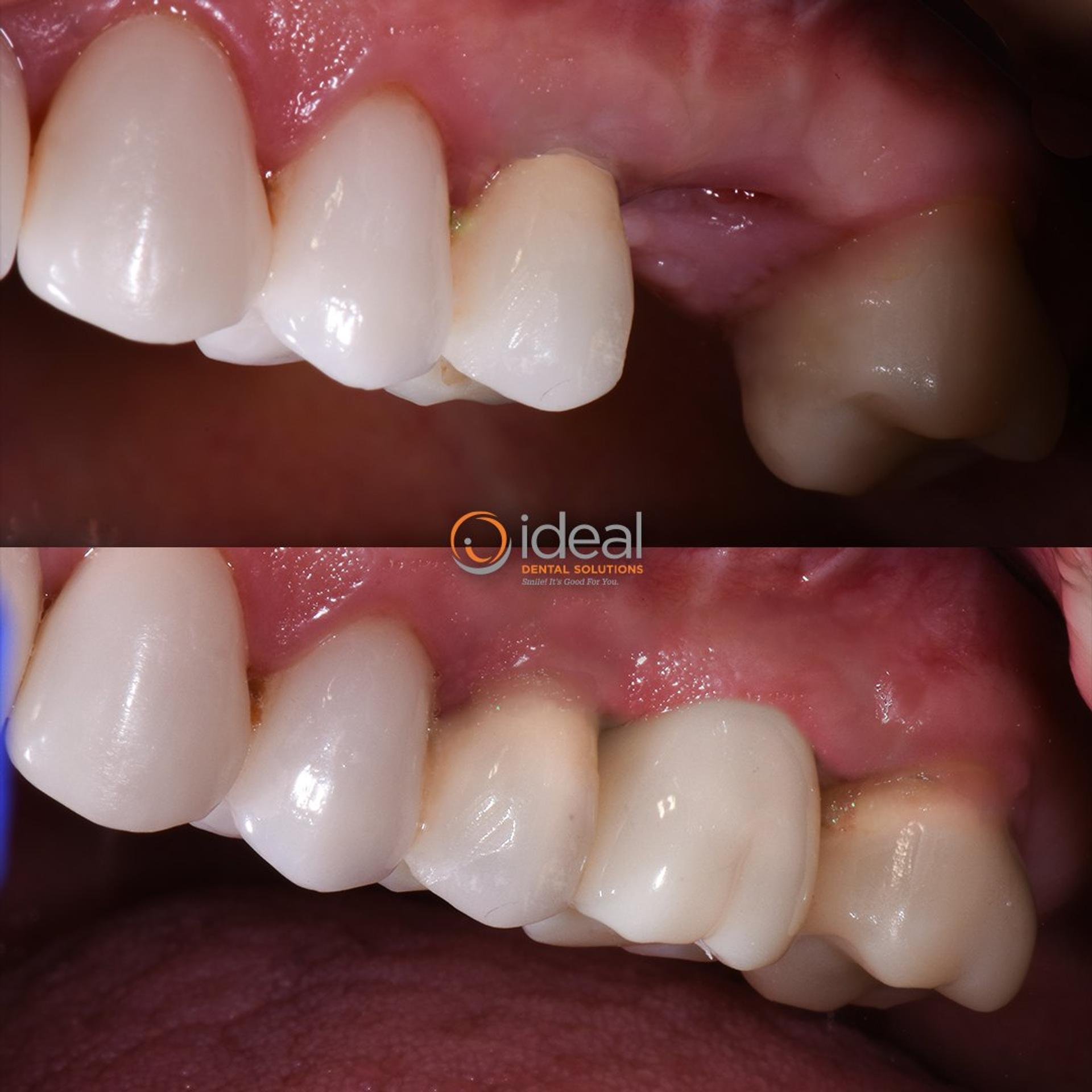 Before and after smile, case 4